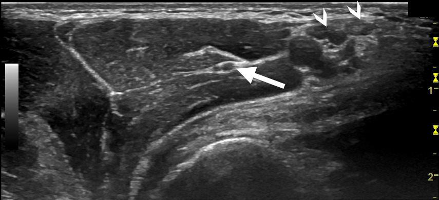 Musculocutaneous Kopie