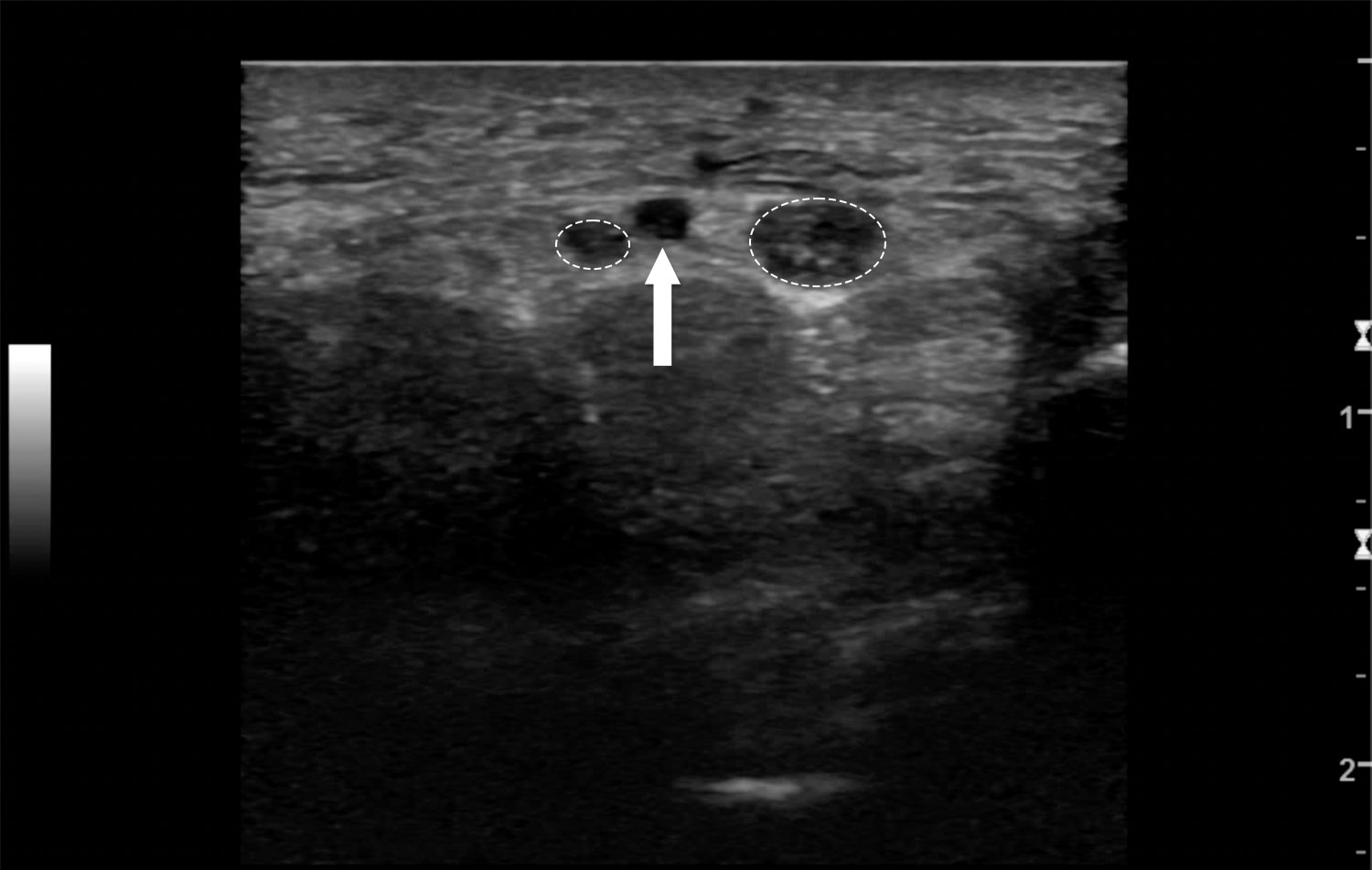 Proximal with arrows Kopie